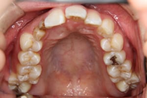 右上は犬歯が埋伏し乳歯が２本残っています。